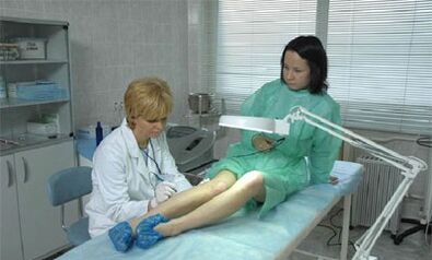 jak leczyć żylaki na nogach