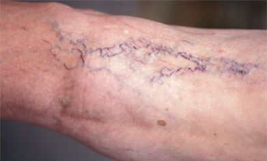 metody leczenia żylaków na nogach