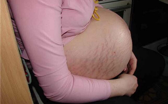 przyczyny żylaków w czasie ciąży