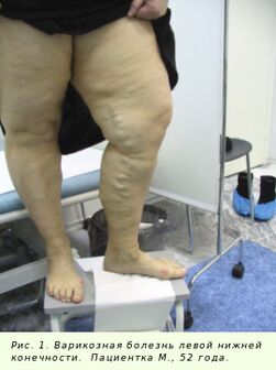 Aby zatrzymać proces, żylaki należy leczyć