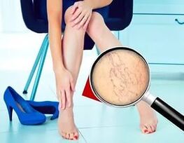 Objawy zależą od rodzaju i stopnia zaawansowania żylaków