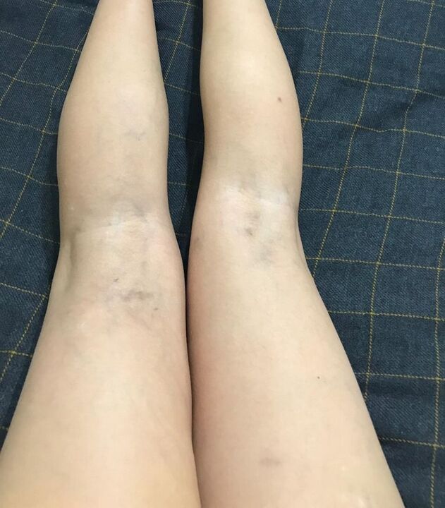 objawy żylaków na nogach