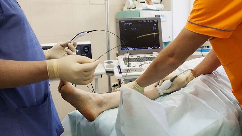 operacja usunięcia żylaków